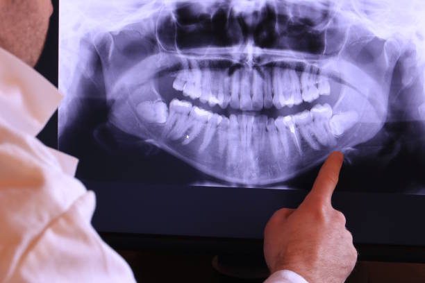 Best Emergency Treatment for Dental Infections or Abscesses in Montclair State University, NJ
