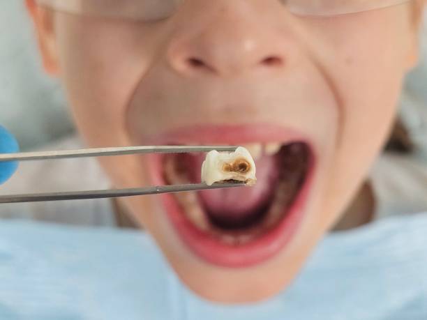 Best Emergency Wisdom Teeth Removal in Montclair State University, NJ